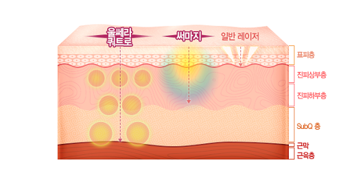 울쎄라 써마지의 차이점, 노화 상태에 맞는 부스트 고르는 방법