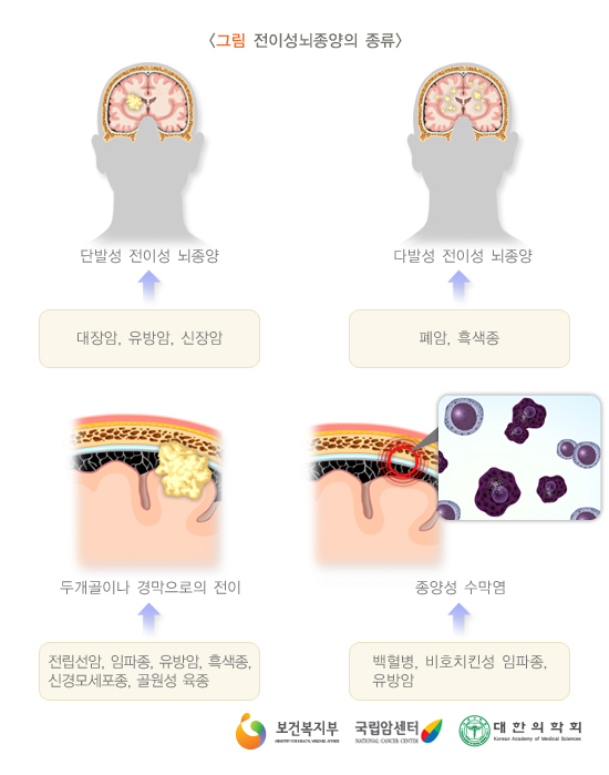 뇌종양의 원인을 규명하고 예전의 건강한 나를 되찾으세요 5