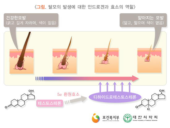 남성의 성호르몬 테스토스테론과 탈모의 연관성