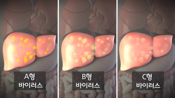 EBS '명의' 간암은 어떻게 시작되는가! 간암초기증상 있을까