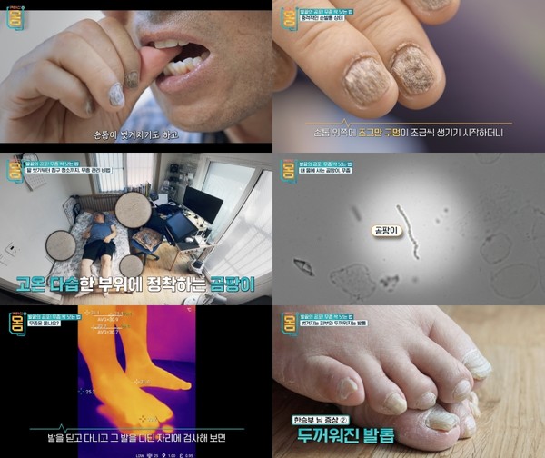 [귀하신 몸] 발끝의 공포, 무좀 확실히 낫는 방법은?...깨끗한 발 만드는 비법 대공개