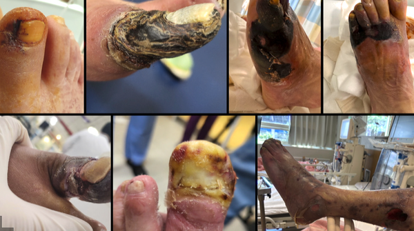 절단까지 부르는 숨은 합병증... ‘당뇨발’의 진실 파헤친다 / 사진=EBS